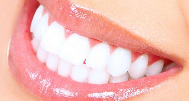 Teeth Whitening